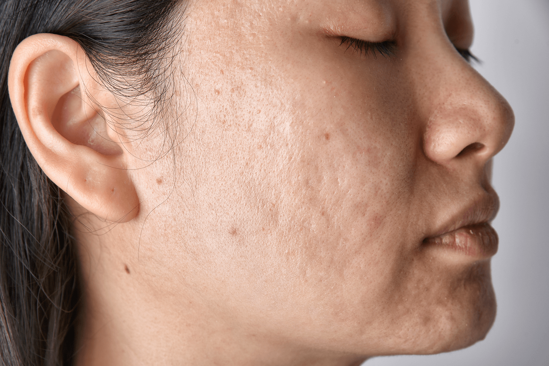 bacne scars treatment
