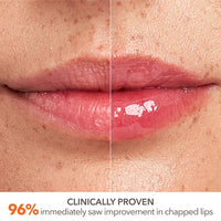 Skip the Lip Filler Bundle (20% Discount)