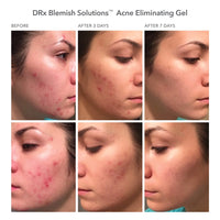 Gel para eliminar el acné DRx Blemish Solutions™