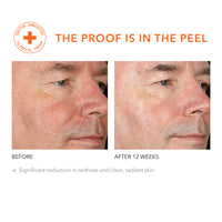 Peel Vault: transforma tu piel en 2 minutos