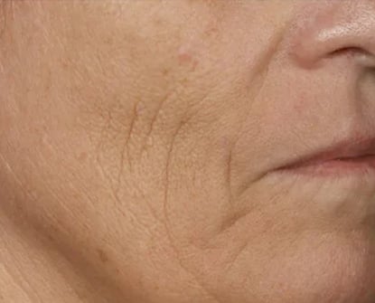 Before Wrinkles Treatment