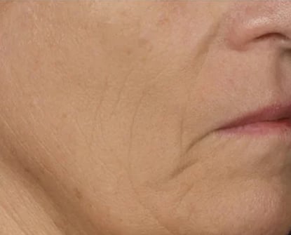 After Wrinkles Treatment