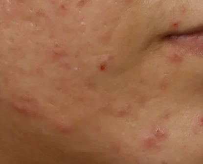 Before Acne Treatment